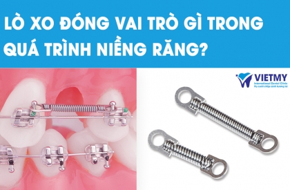 Lò Xo Niềng Răng Và Vai Trò Quan Trọng Trong Quá Trình Niềng Răng Mắc Cài